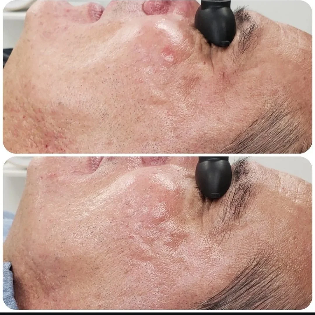 Before and after — Advanced Microneedling