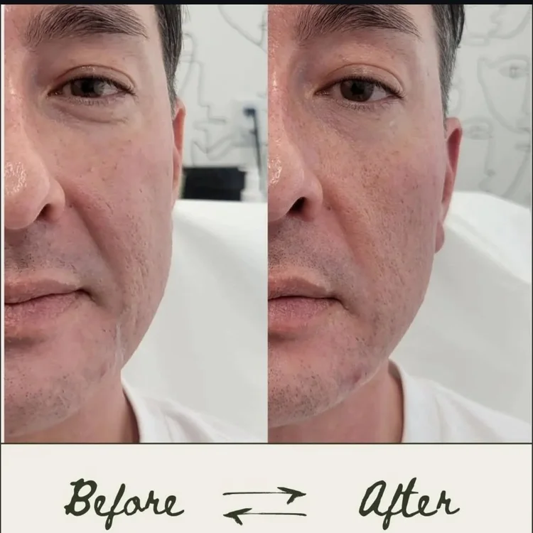 Before and after — Advanced Microneedling