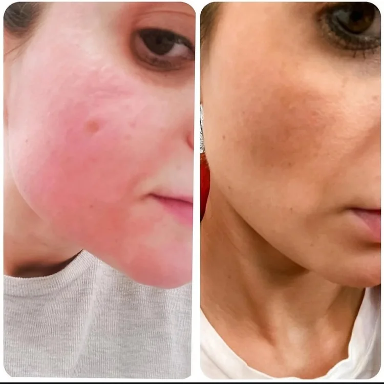 Before and after — Advanced Microneedling