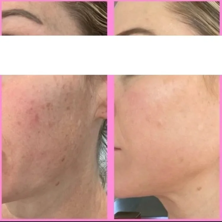 Before and after — Advanced Microneedling