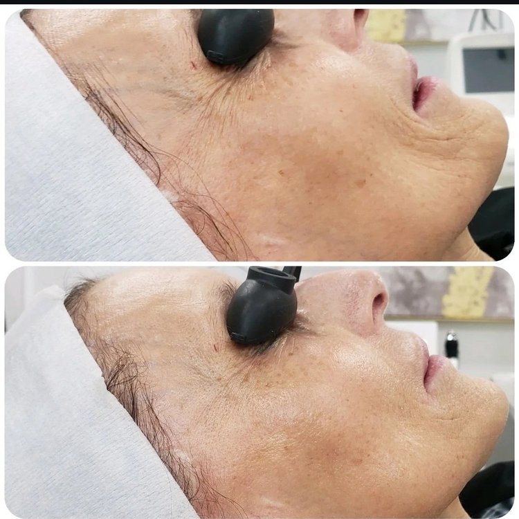 Before and after — Advanced Microneedling