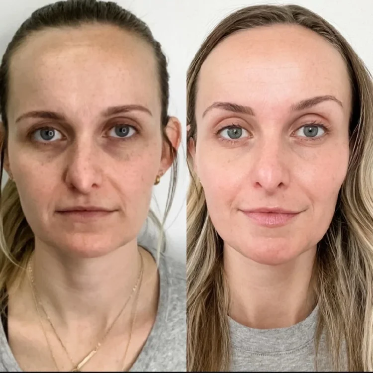 Before and after — Advanced Microneedling
