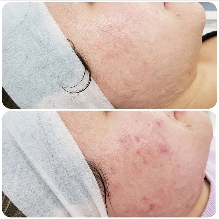 Before and after — Advanced Microneedling