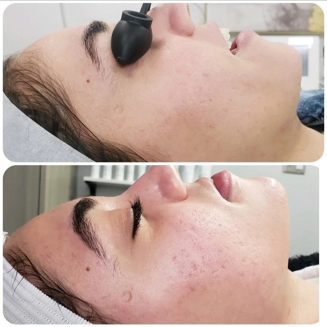 Microneedling, Chemical Peel & Cool Peel