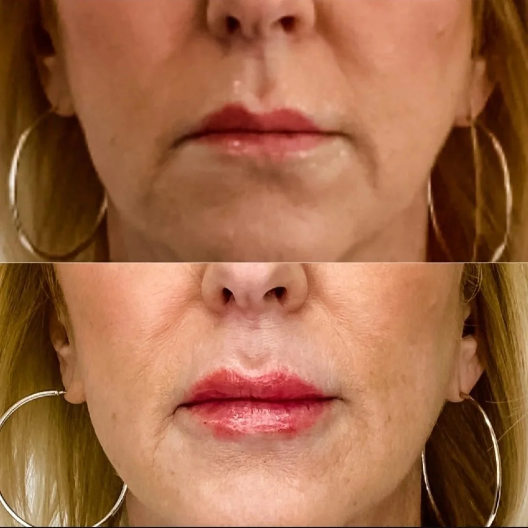 1/2 Syringe of Lip Filler