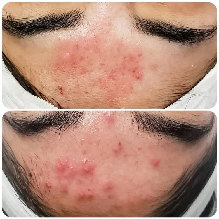 Before and after — Advanced Microneedling