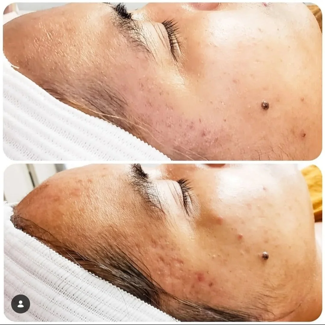 Microneedling