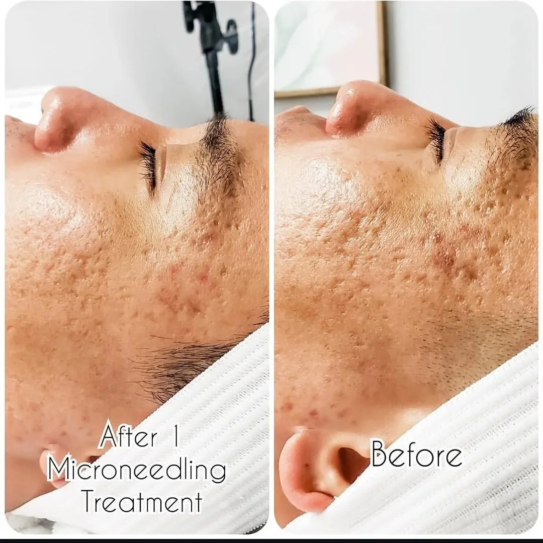 Microneedling