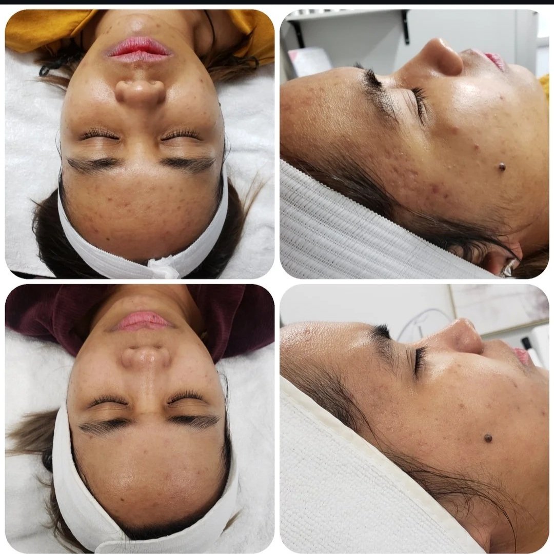 Microneedling & Chemical Peel
