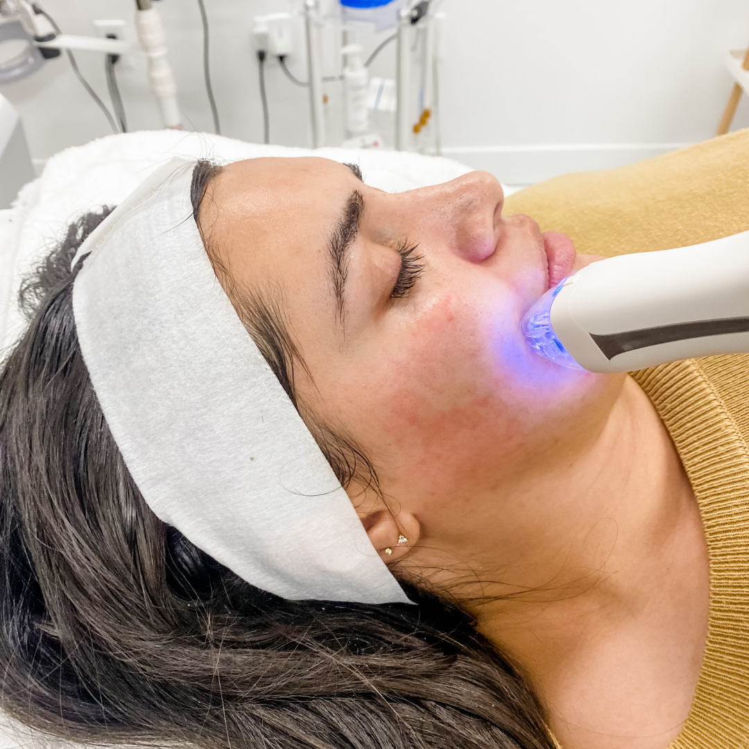 How Many RF Microneedling Sessions Does It Take for Acne Scars?