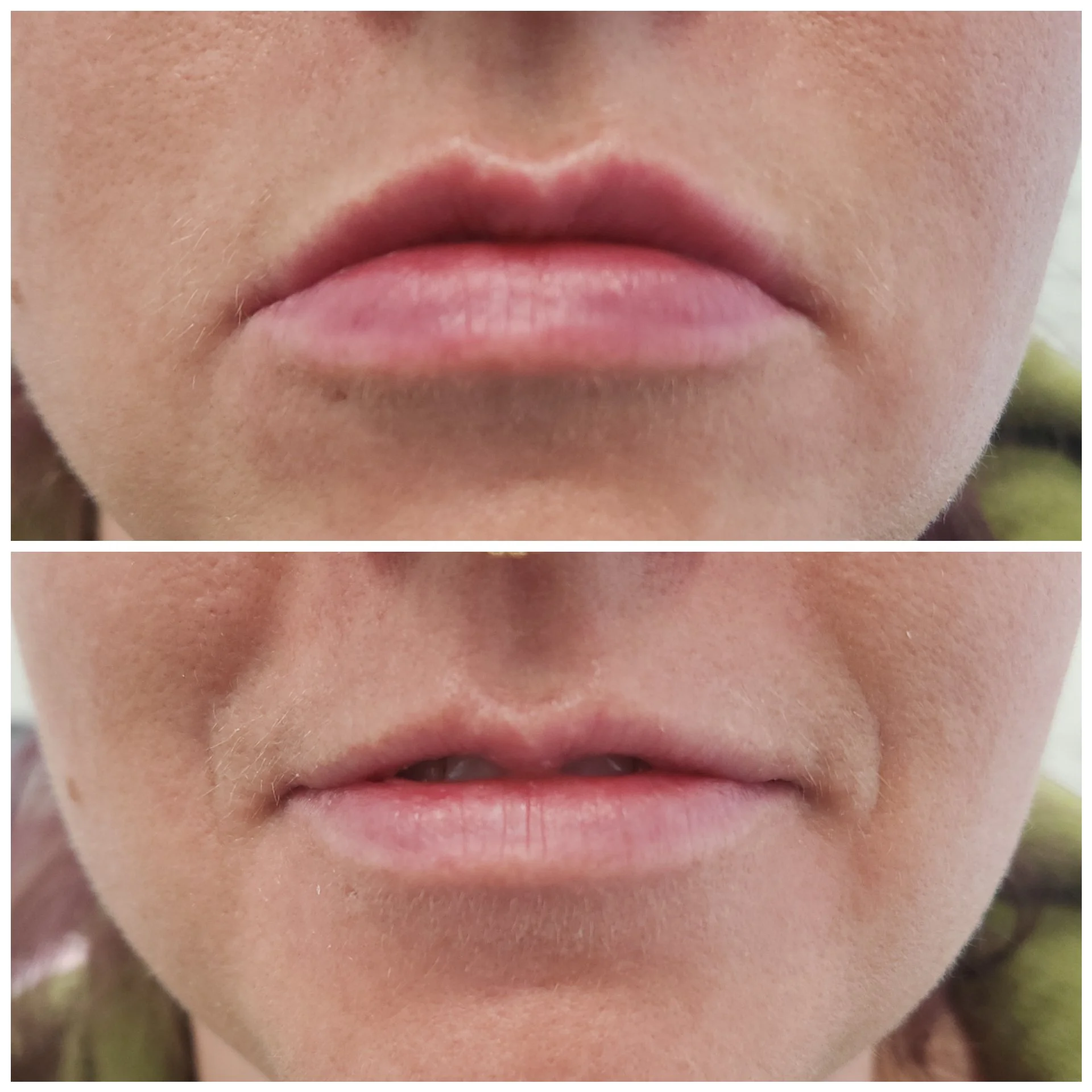 1/2 Syringe of Filler