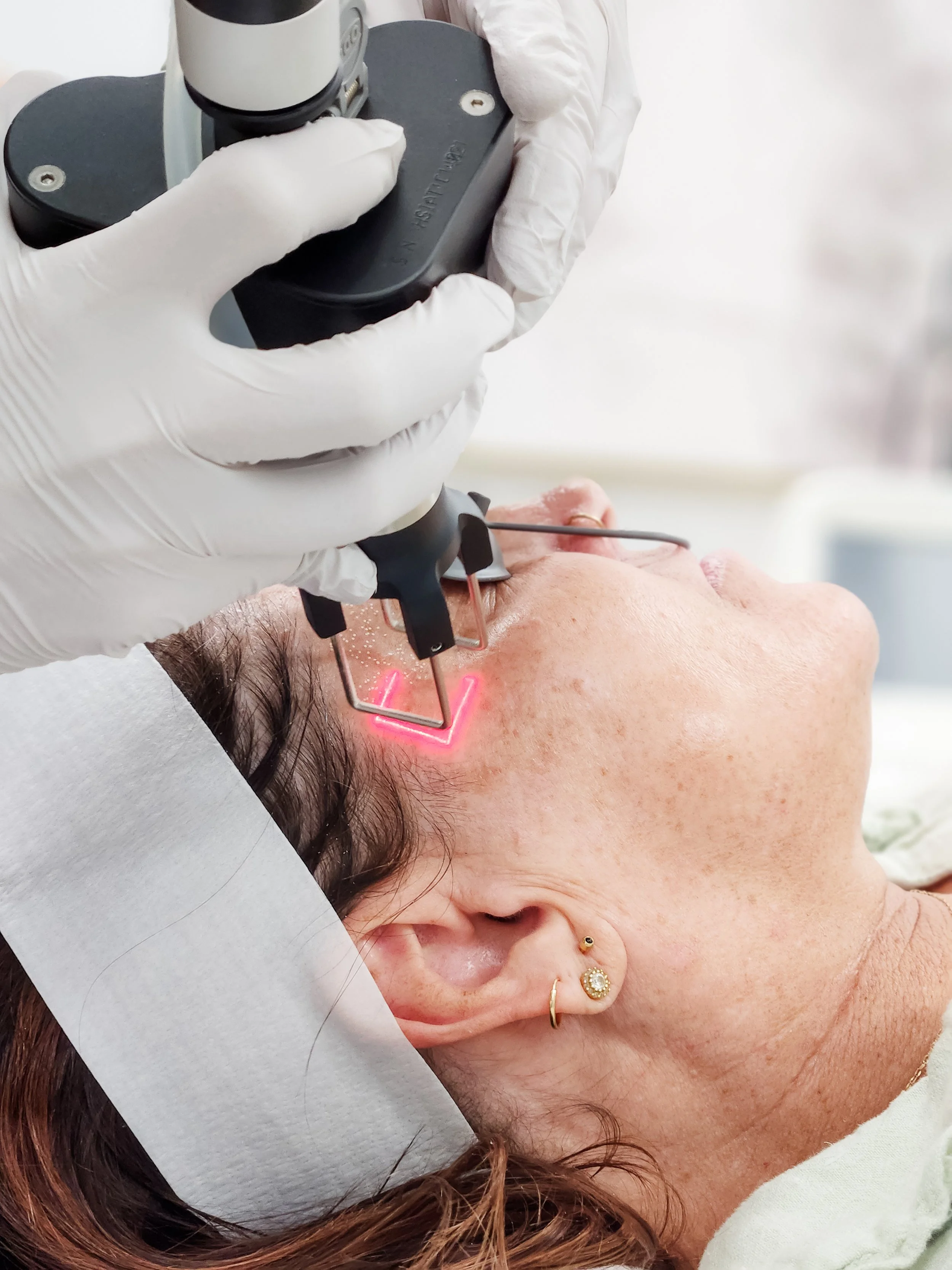 cool peel, co2 laser, anti-aging treatment, laser treatment, deep wrinkles,