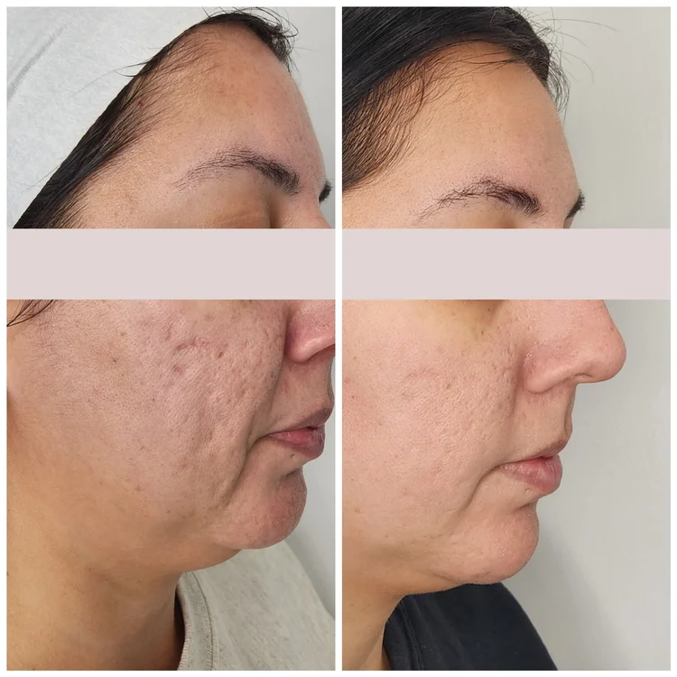 Before and after — DEKA Deep Peel