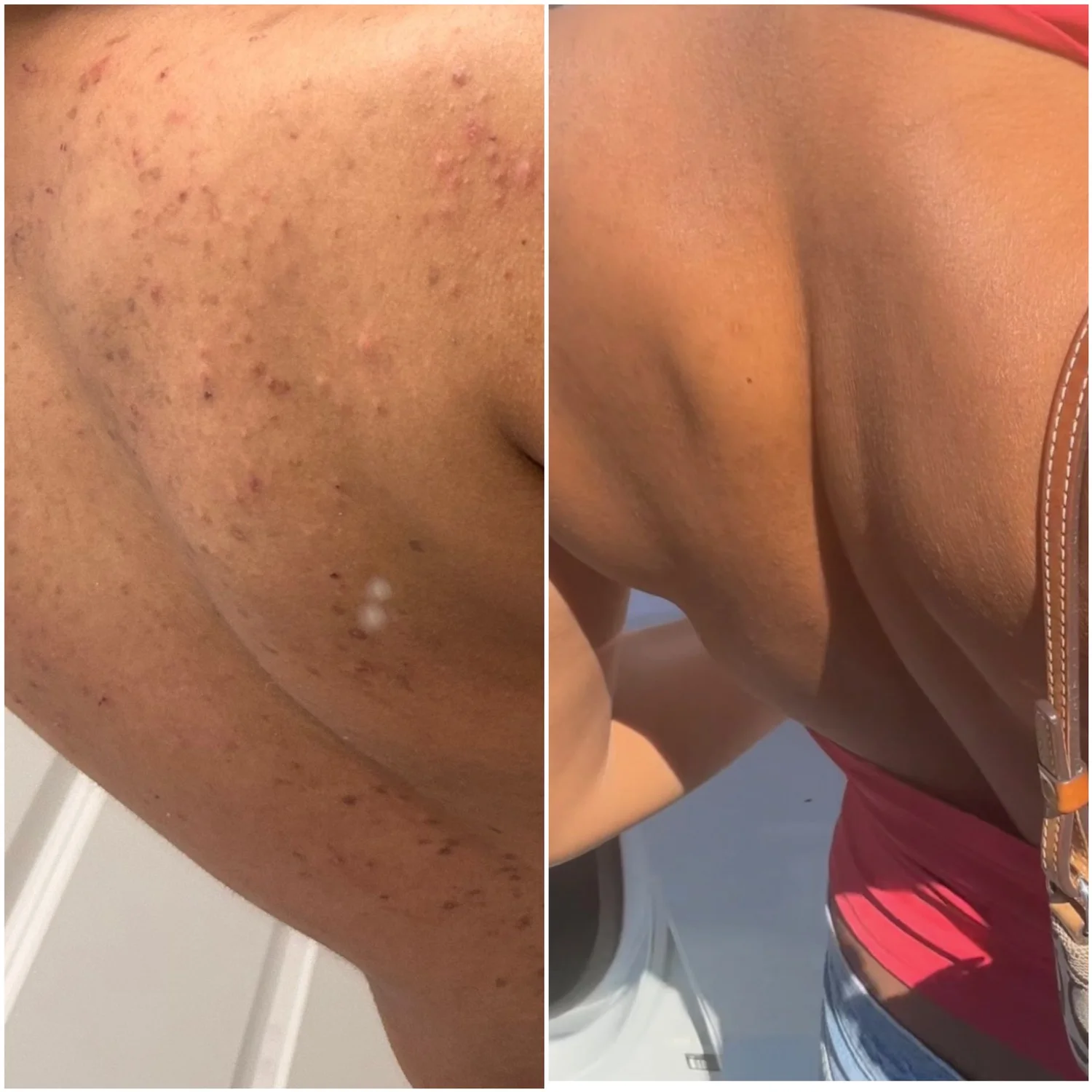 Before and after — Advanced Microneedling