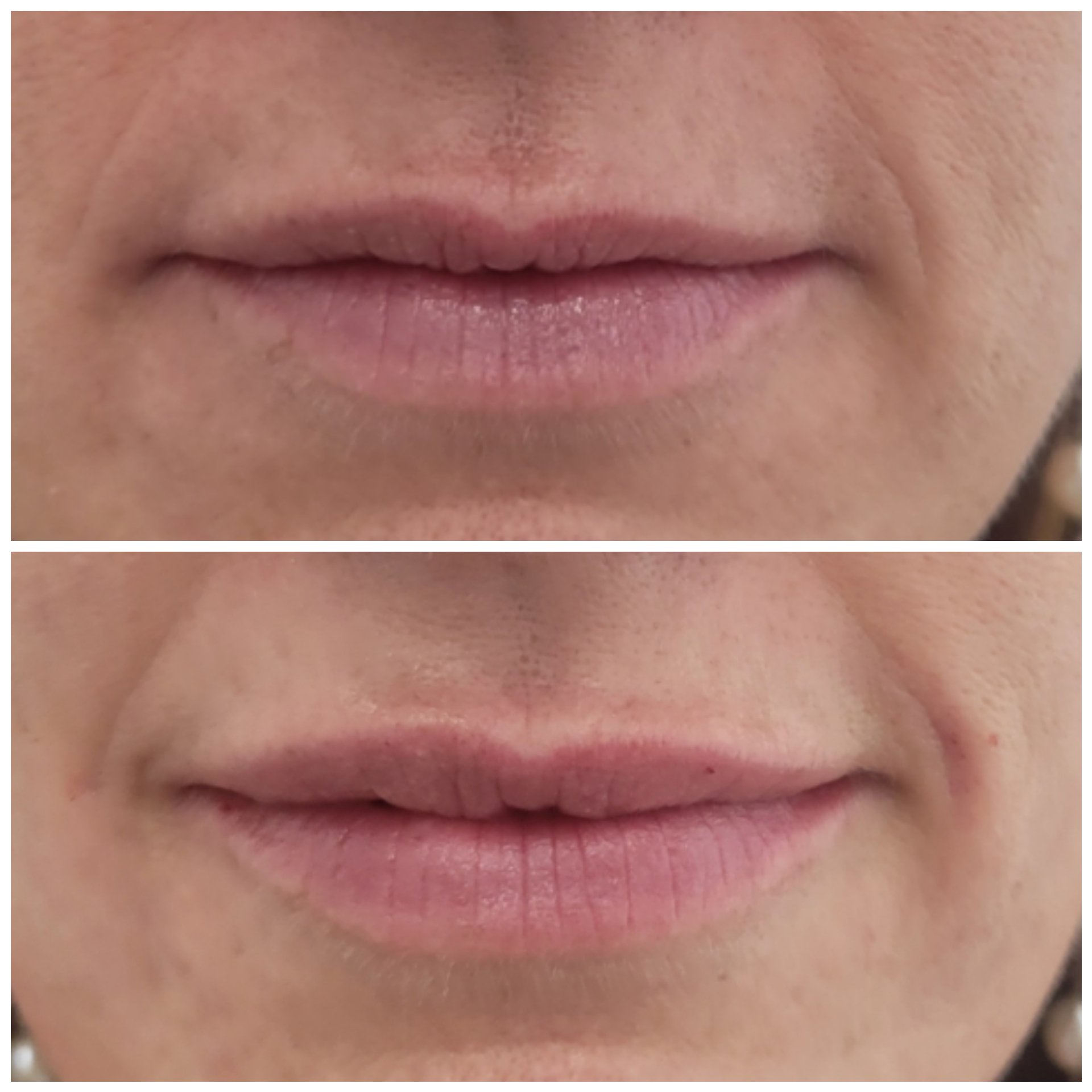 1/2 Syringe of Lip Filler