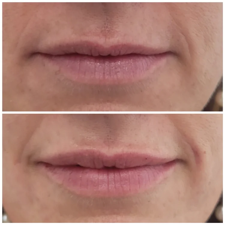 Before and after — Advanced Microneedling