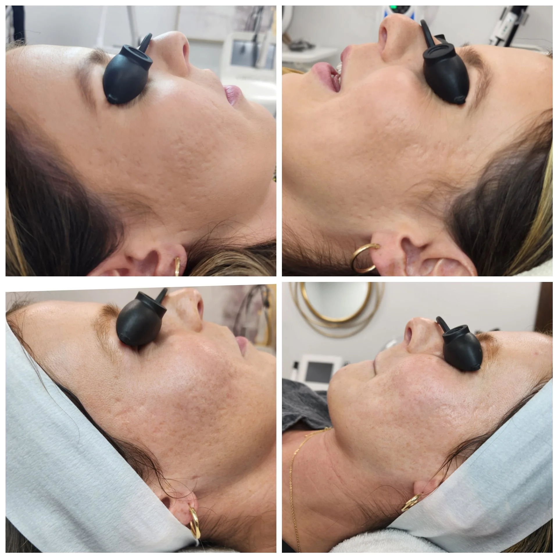 Microneedling