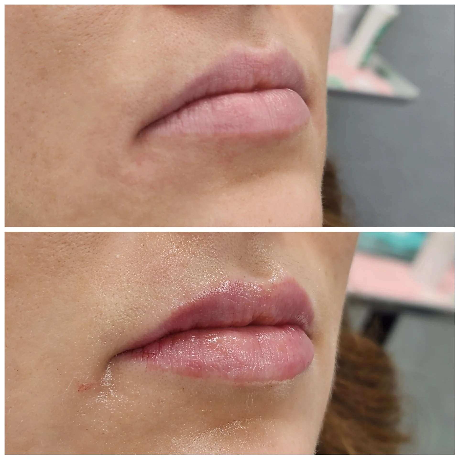 subtle lip filler, lip volume, lip filler, lip plump, lip pout, rha, restylane, juvederm