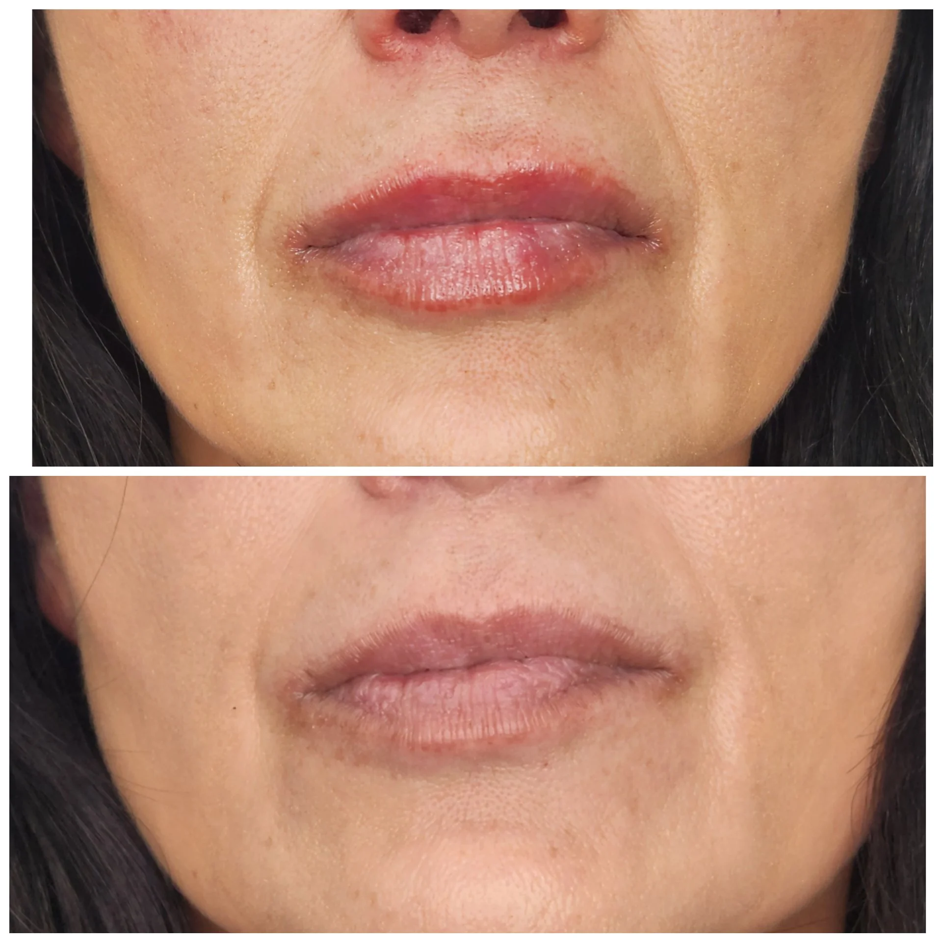 1/2 Syringe of Filler