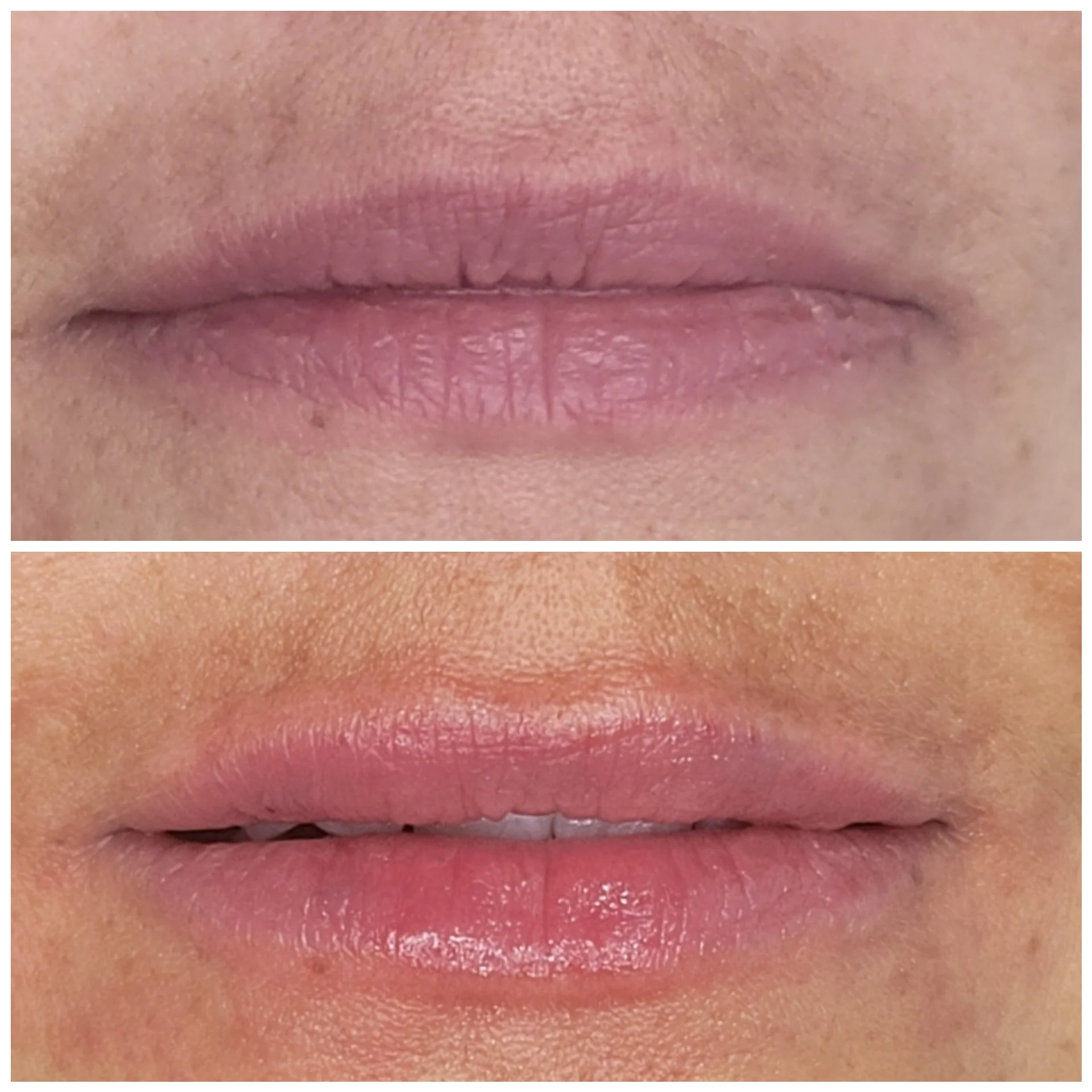 1/2 Syringe of Filler