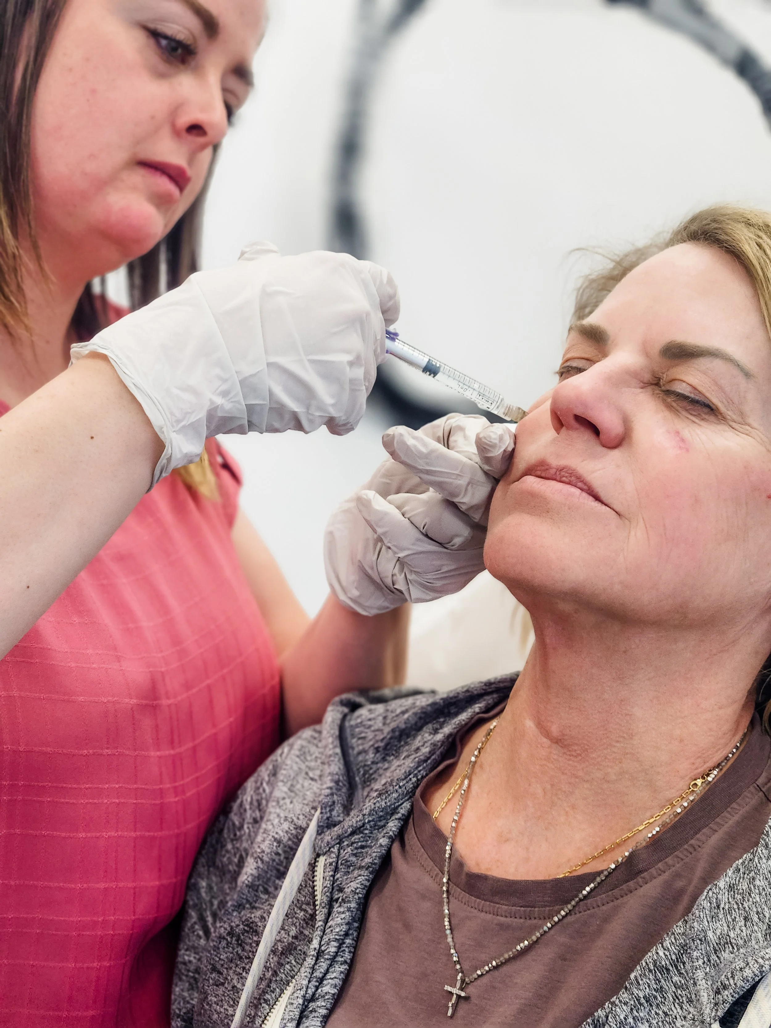 hyper radiesse, dermal filler, pdgf, cheek filler. jawline filler, structural filler