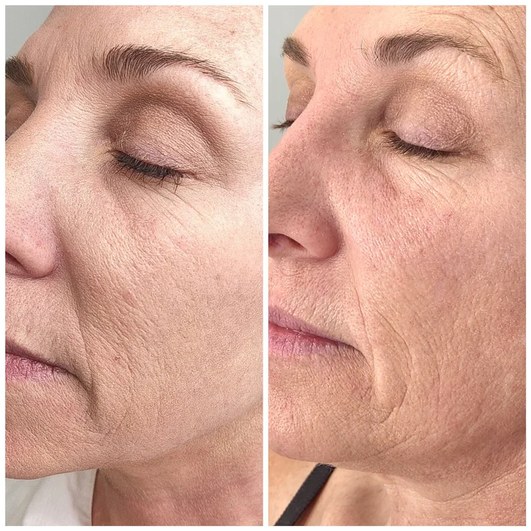 Before and after — RF Microneedling
