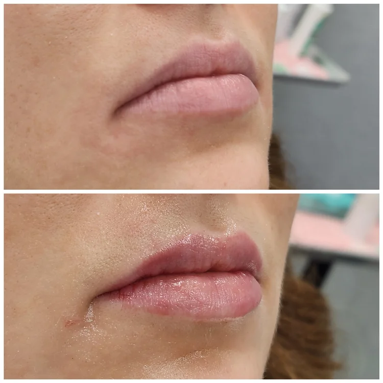 Before and after — Advanced Microneedling