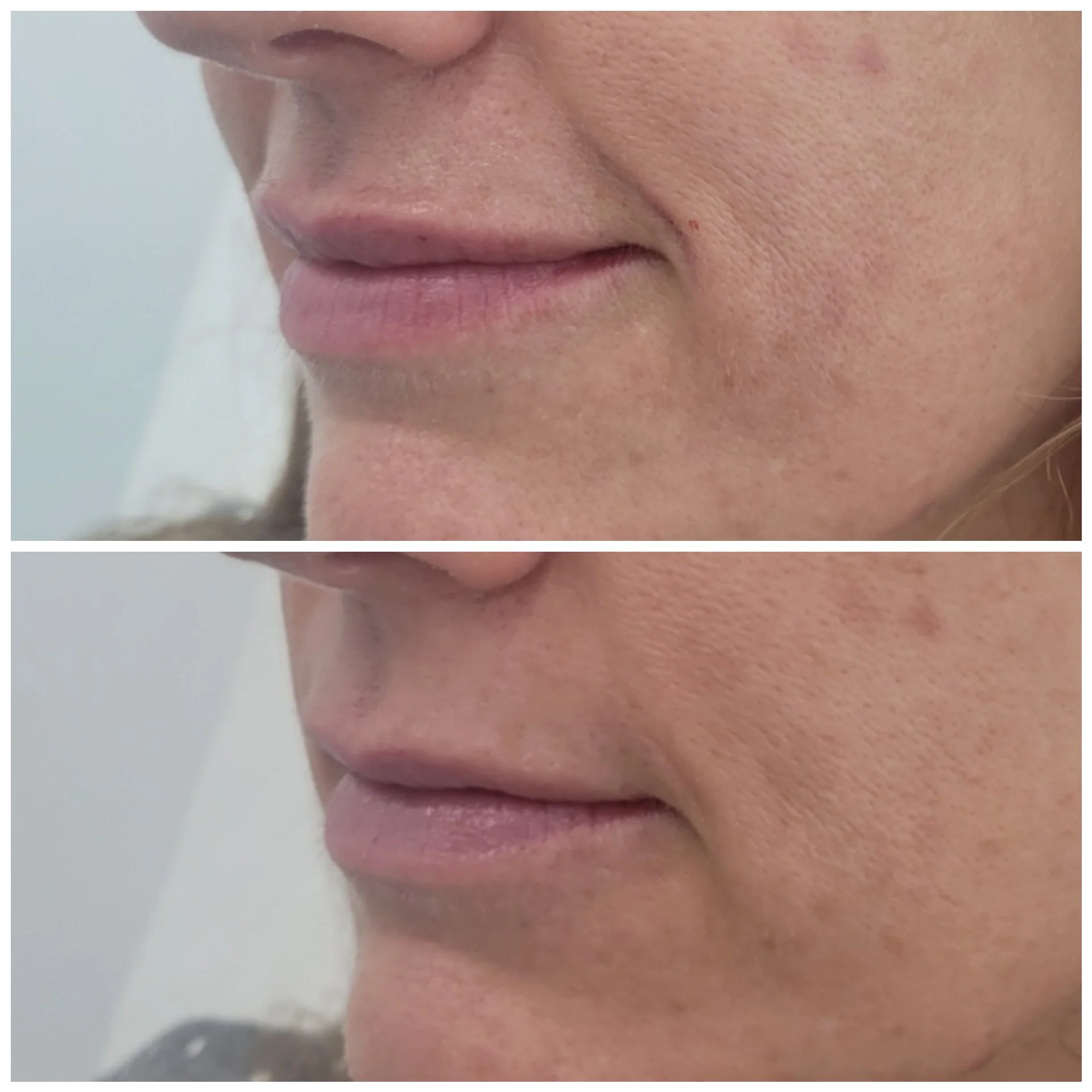 1/2 Syringe of Lip Filler