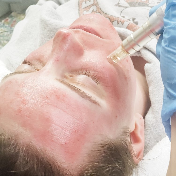 Advanced Microneedling