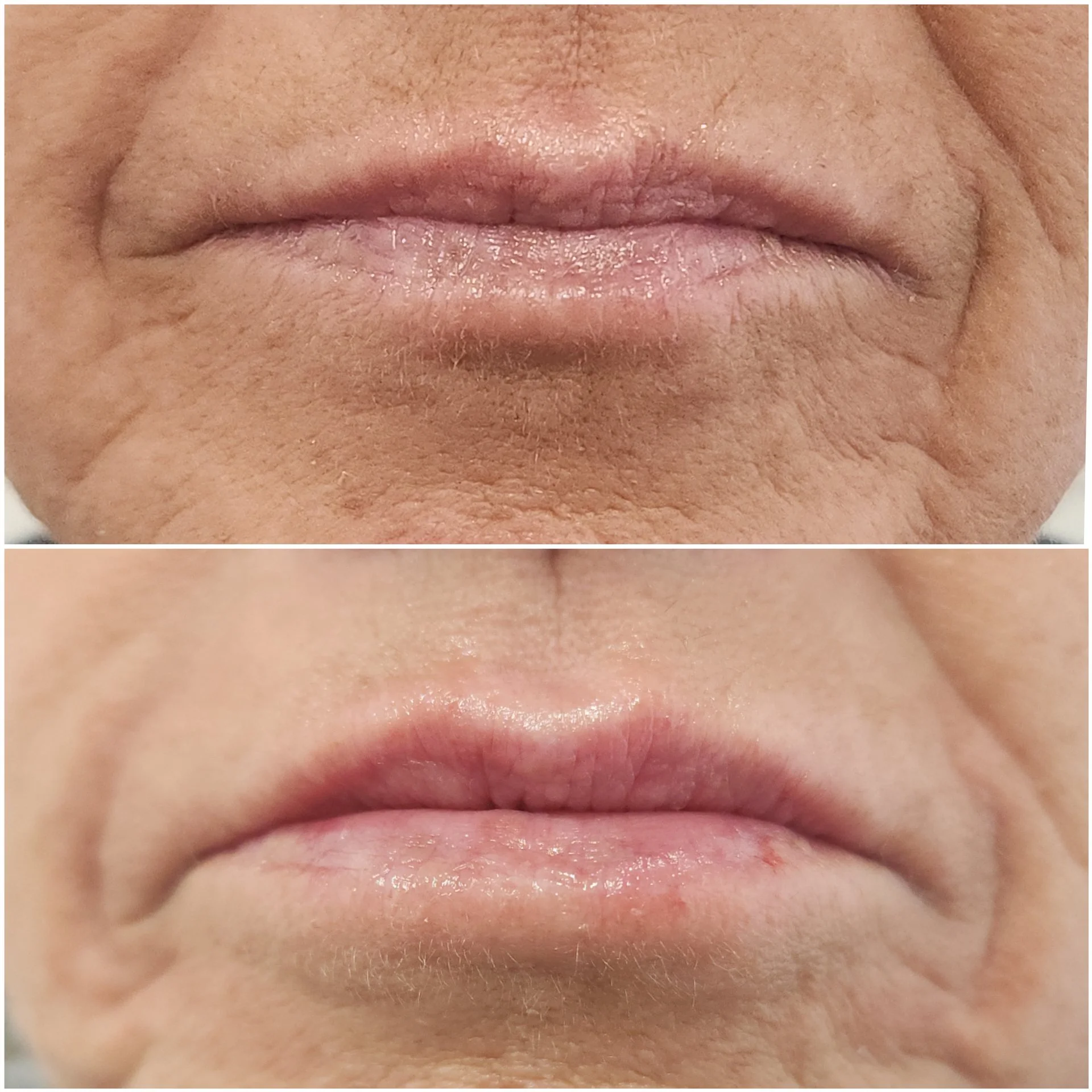 1/2 Syringe of Filler