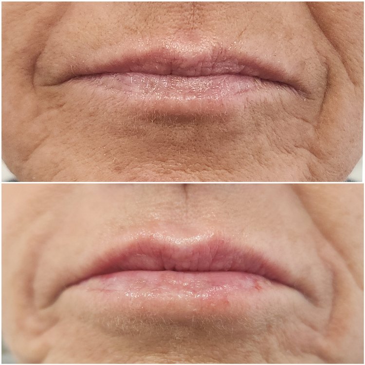 Before and after — Advanced Microneedling