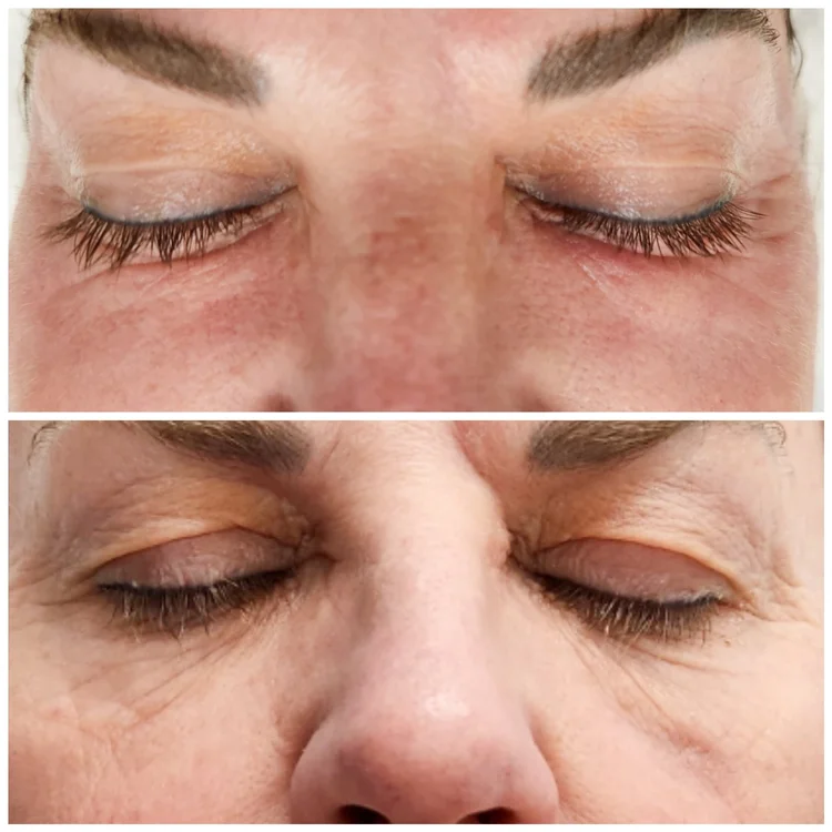 Before and after — Advanced Microneedling