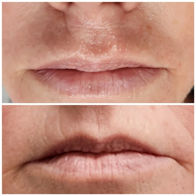 Before and after — Advanced Microneedling