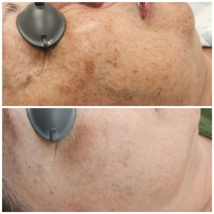 Before and after — Lighten & Brighten