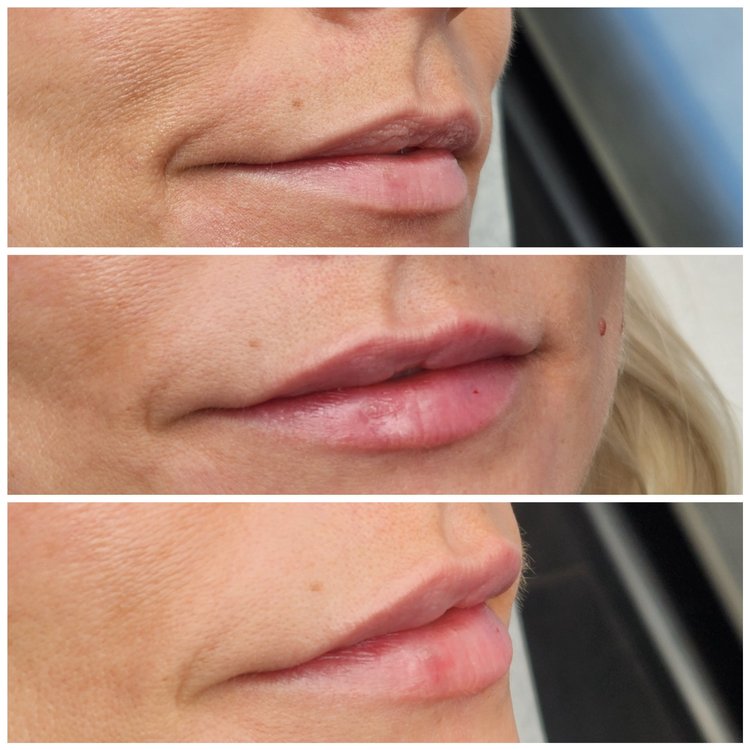 Before and after — Advanced Microneedling