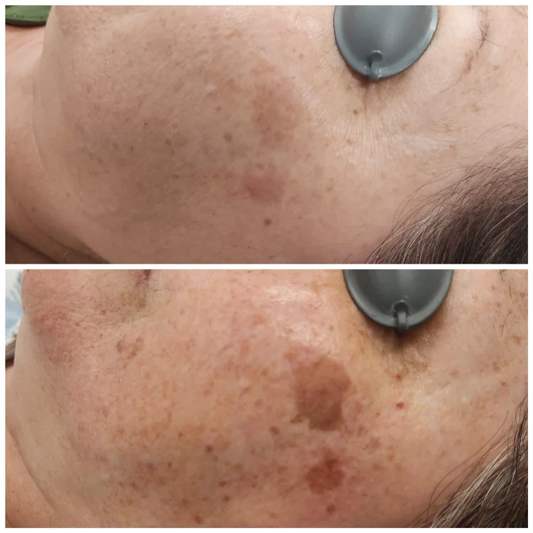 Before and after — Advanced Microneedling