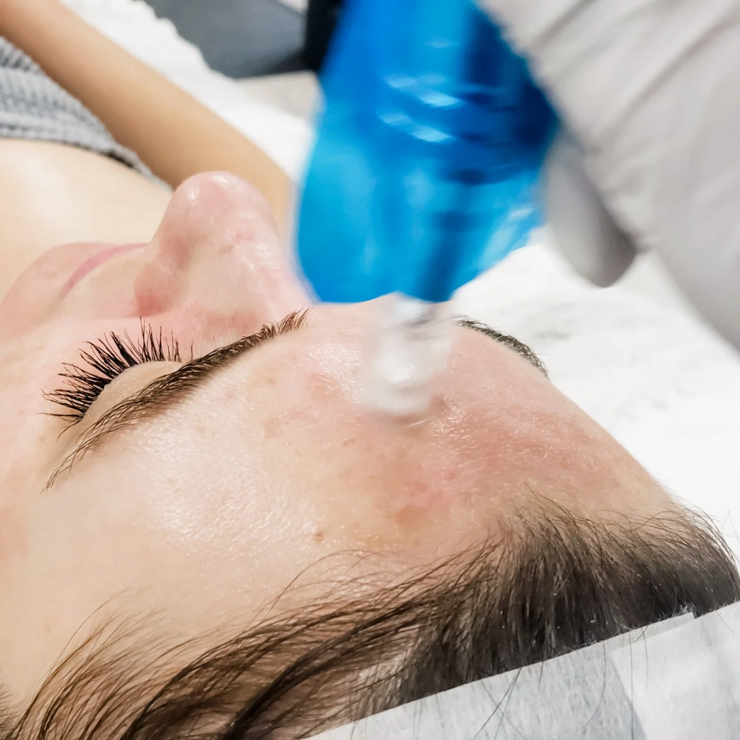 Advanced Microneedling