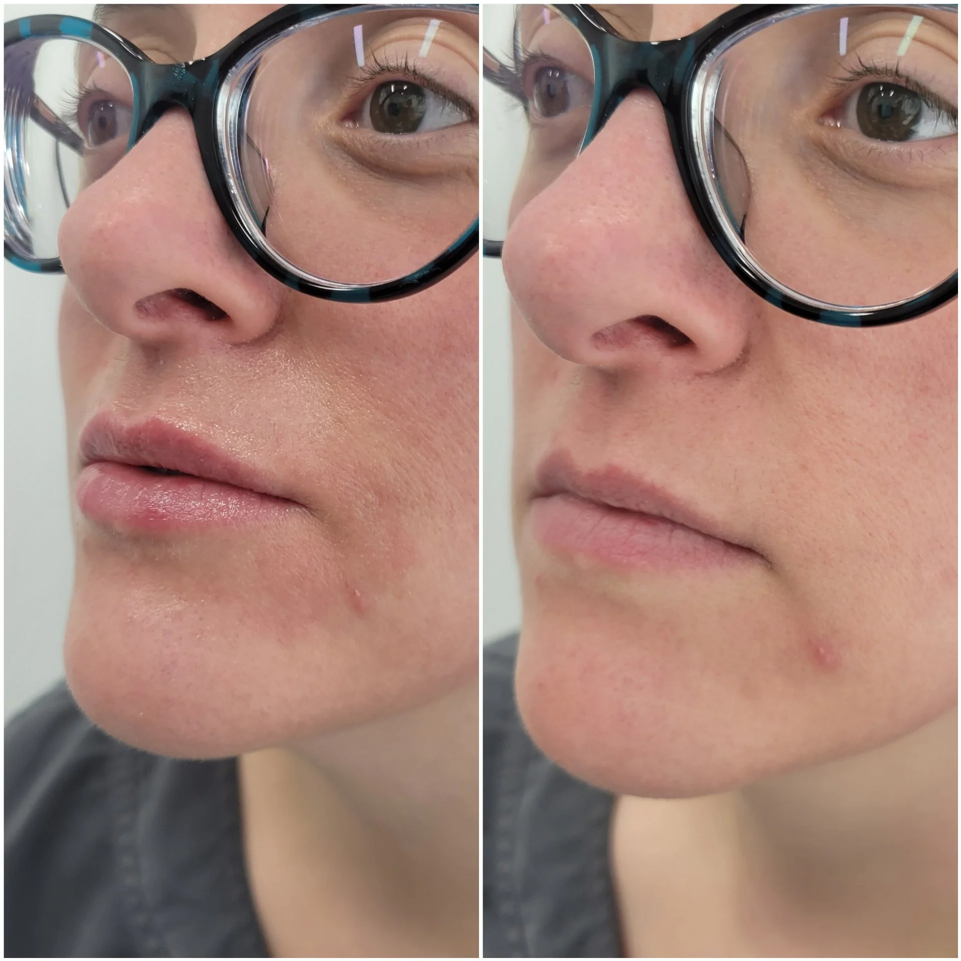 1/2 Syringe of Filler