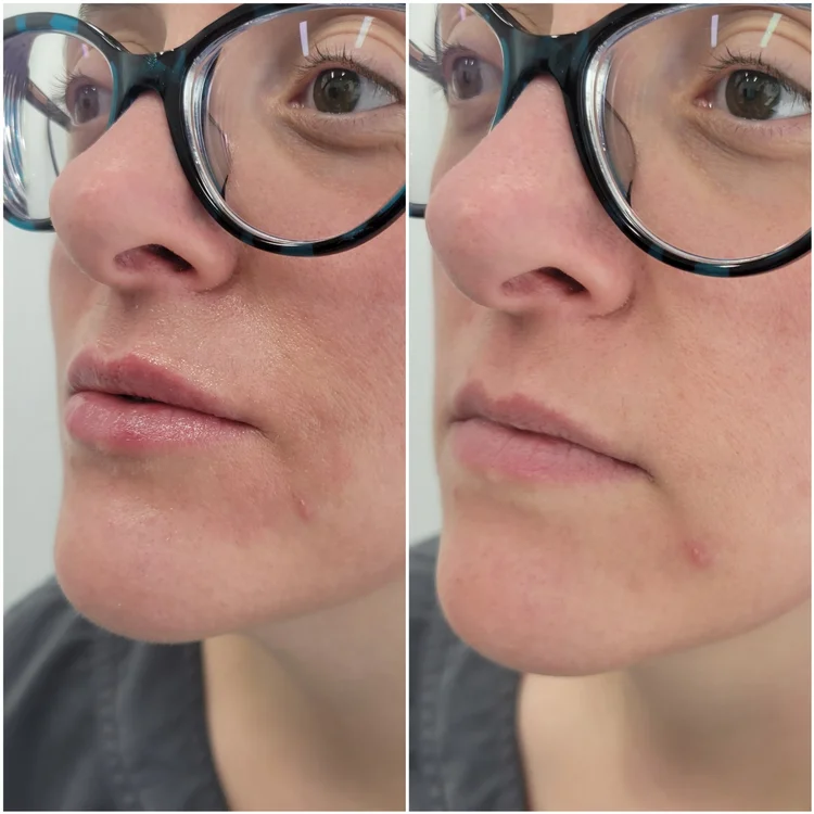 Before and after — Advanced Microneedling