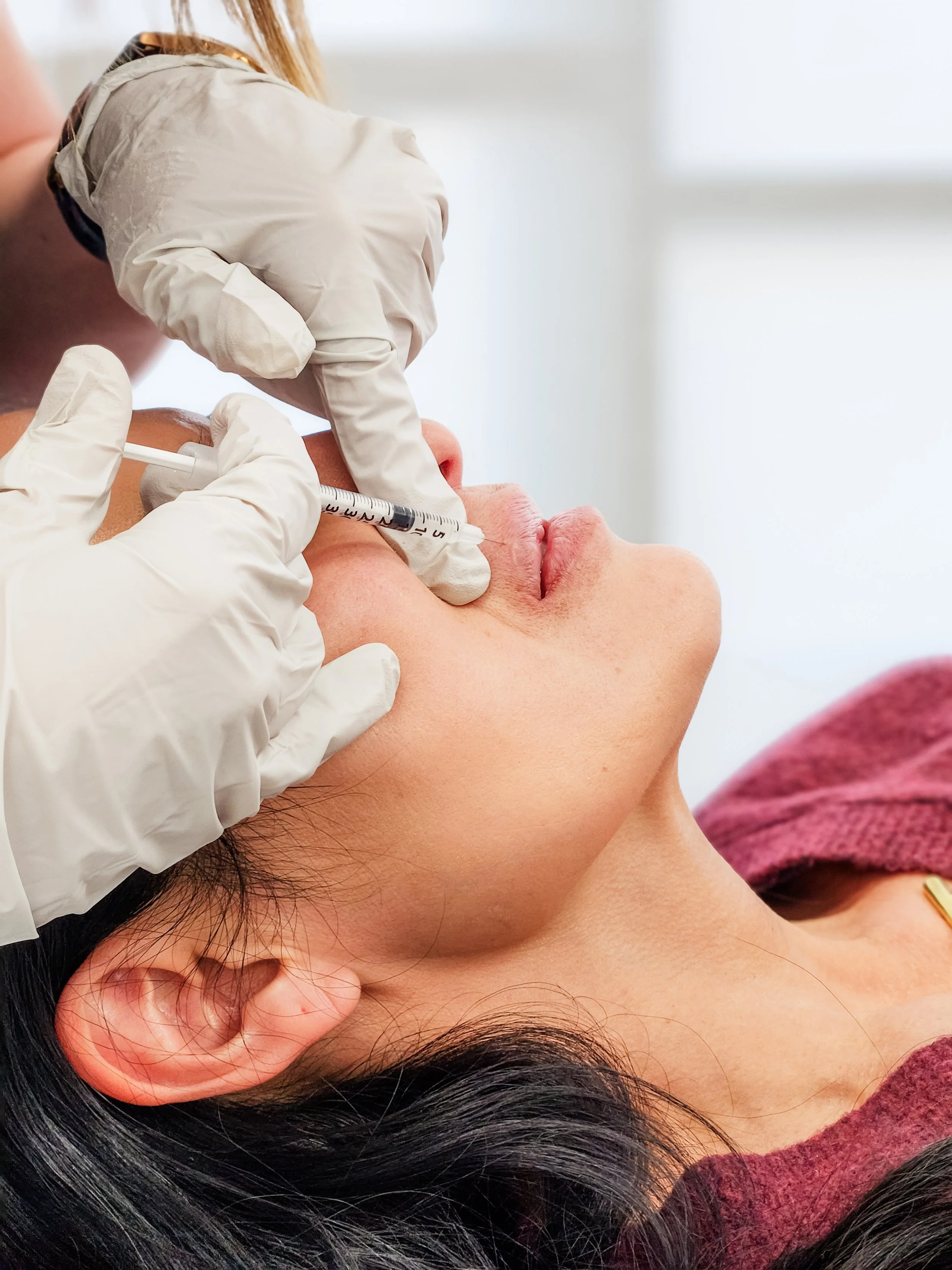 lip filler, dermal filler, rha, juvederm, restylane, cheek filler, chin filler, full syringe of filler, natural filler, dermal filler