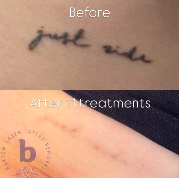 Newer tattoos are harder to lift, this one required 11 treatments + due to the age of it