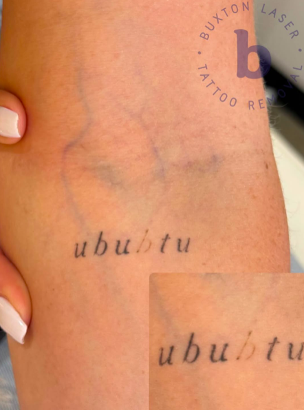 The B needs to be removed, this is after only 1 treatment