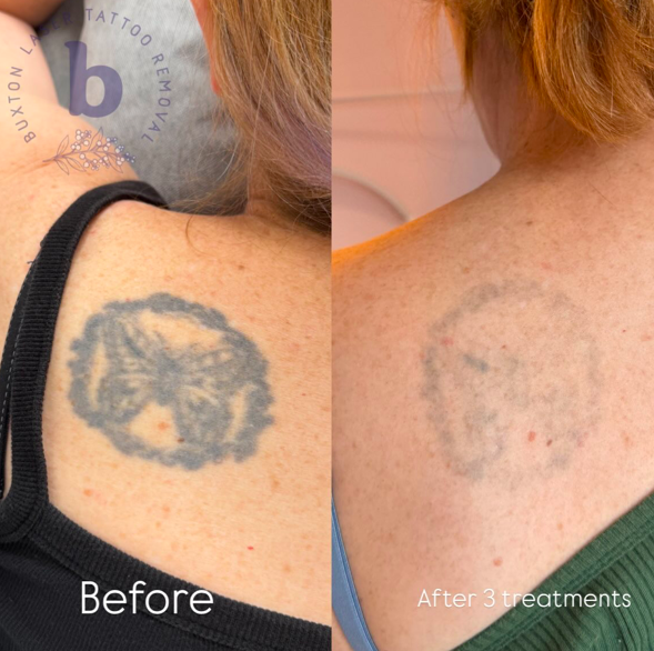 Older tattoos require less treatments