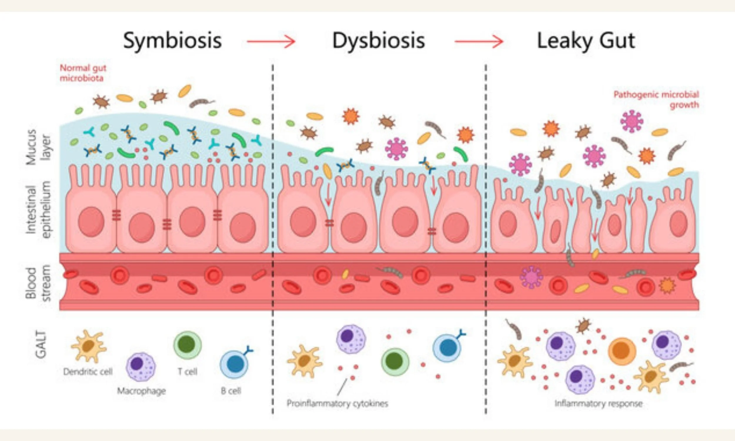 Leaky gut: How SIBO affects the gut barrier and large intestinal microbiome leading to inflammation and digestive symptoms