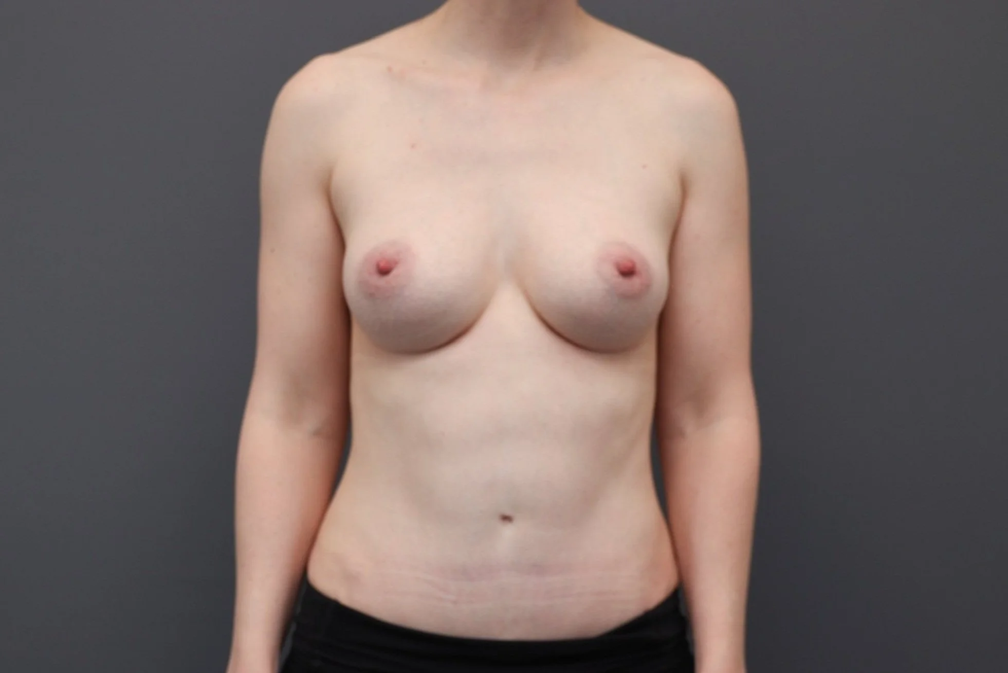 Mommy Makeover After