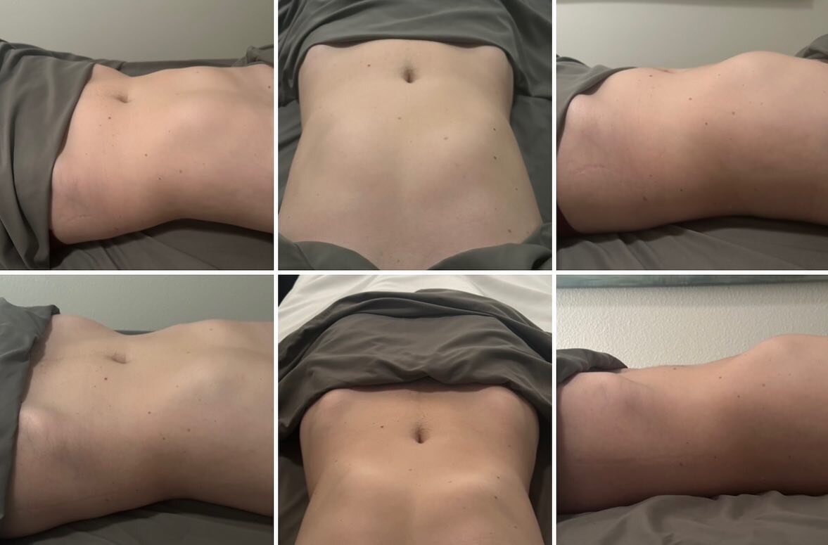 Top 3images are before a 30min session and bottom 3 are the morning after! ✨ Client is early 20&rsquo;s and was on her 2nd day of menstrual cycle with some bloating and general inflammation. I performed a Lymphatic Sculpting treatment and we got grea