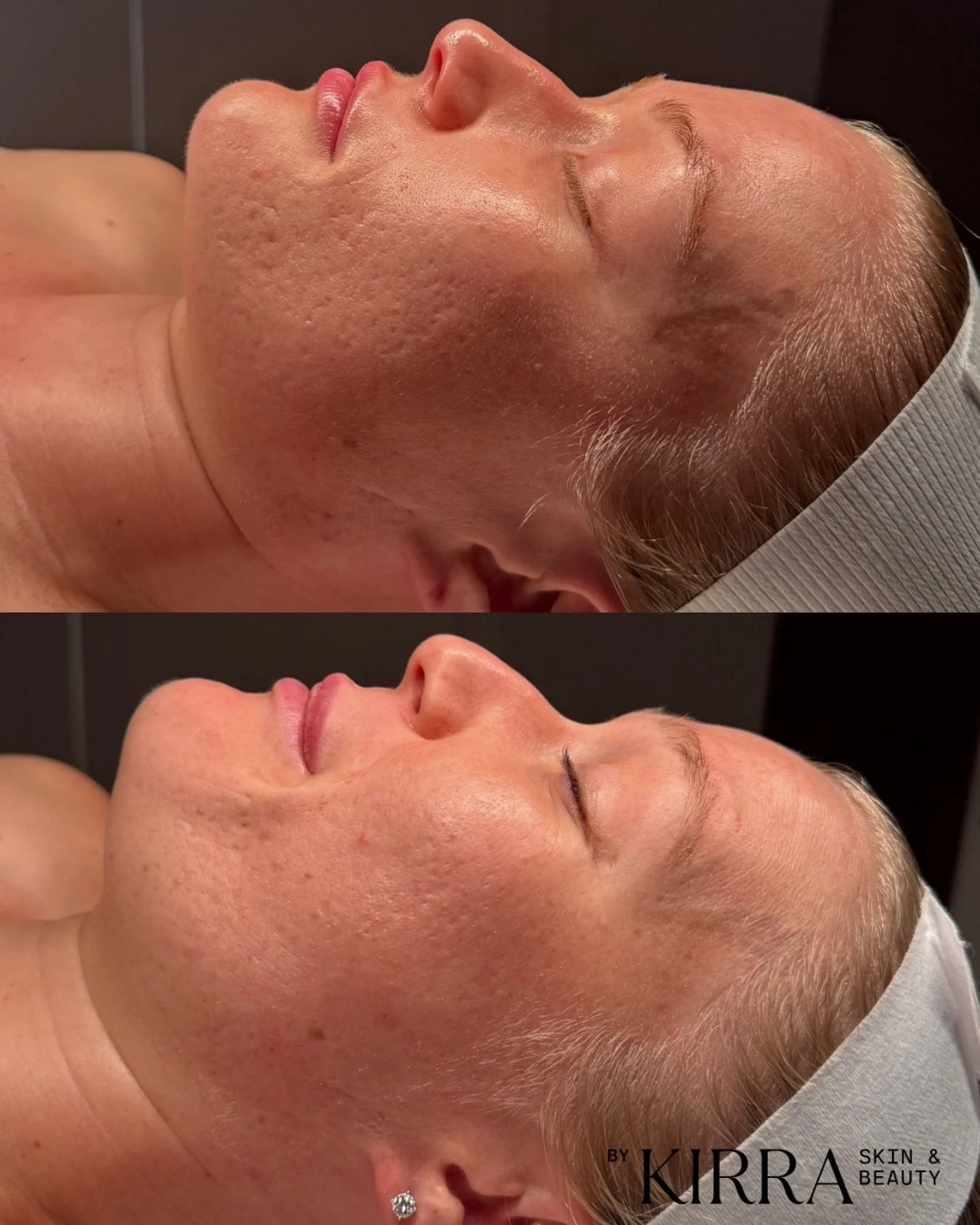 Progress speaks for itself ✨

If you&rsquo;ve been thinking about trying BioRePeel, let this before &amp; after be your sign.

Kate has completed 5 BioRePeel treatments, alongside a personalised skin routine recommended by Kirra. Her scarring has vis