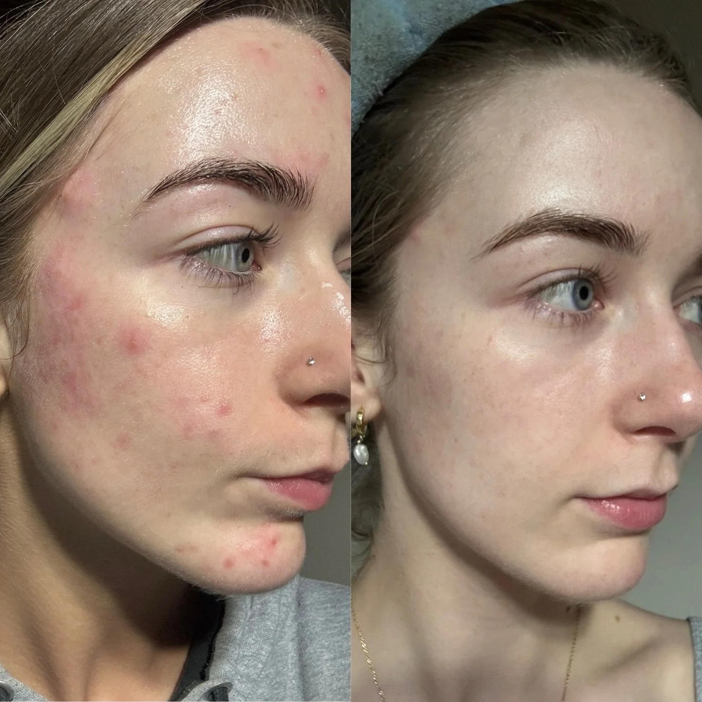 Consistency is everything when it comes to skin.
Georgia has been taking Vida Glow Clear capsules, supporting her skin from within while we work topically in studio.
Less inflammation, fewer breakouts, and a stronger skin barrier.