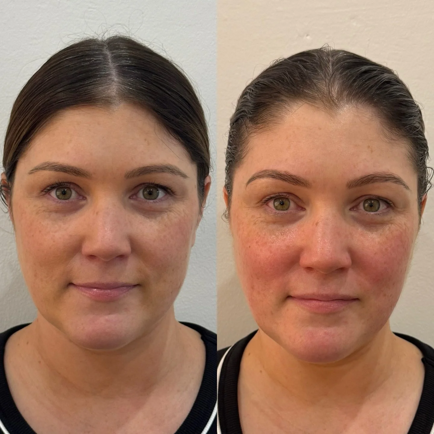 Snatched, sculpted, and lifted naturally

This is the power of the NeoLift Buccal facial after one session. Working deep within the facial muscles to release tension, boost circulation, and redefine your natural contours

No filler. No downtime. Just