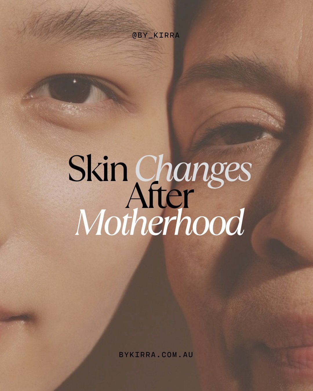 Motherhood changes everything&hellip; including your skin.

If your skin has been feeling different lately, you&rsquo;re not imagining it. Hormones, stress and lack of sleep can all play a role in how your skin looks and feels.

This Mother&rsquo;s D